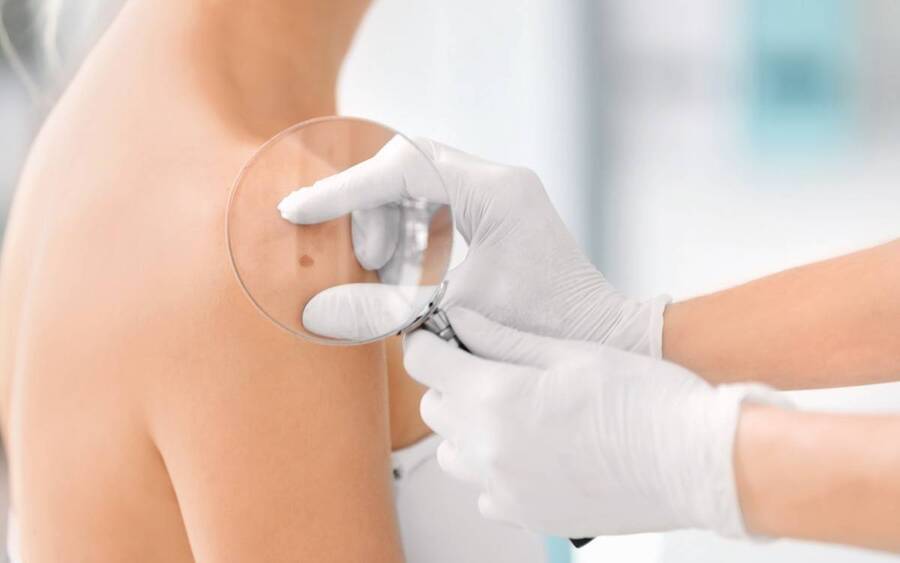 A patient is checked for skin cancer, including melanoma.