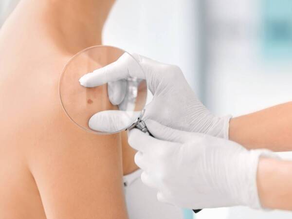 A patient is checked for skin cancer, including melanoma.